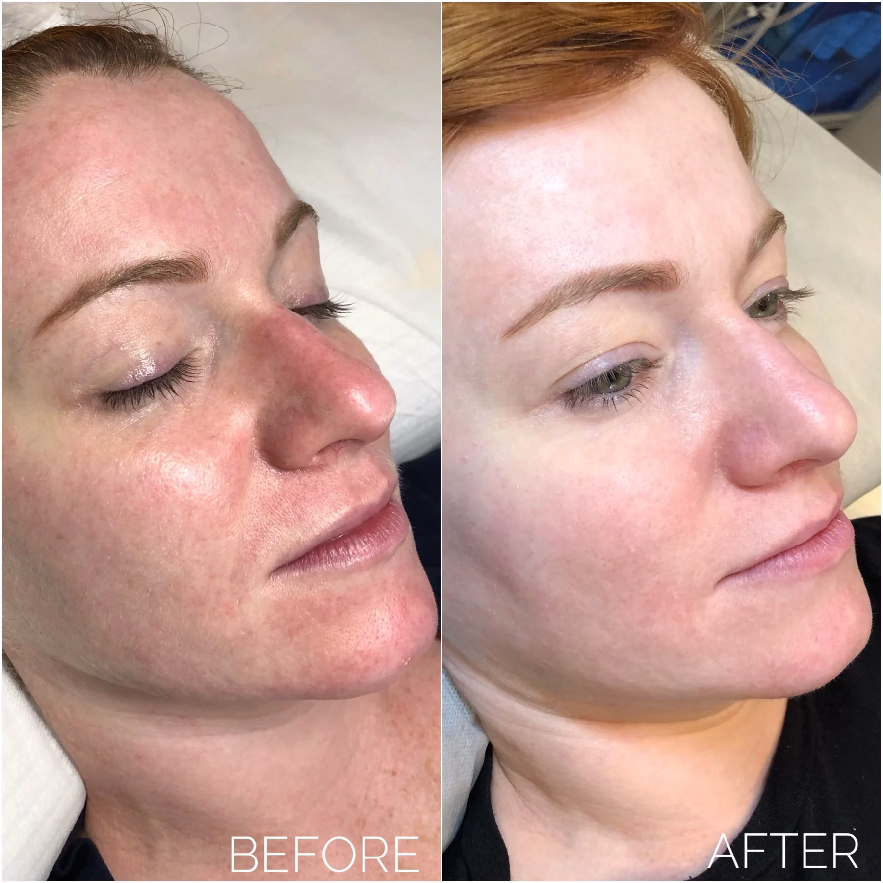 dermapen, bb glow